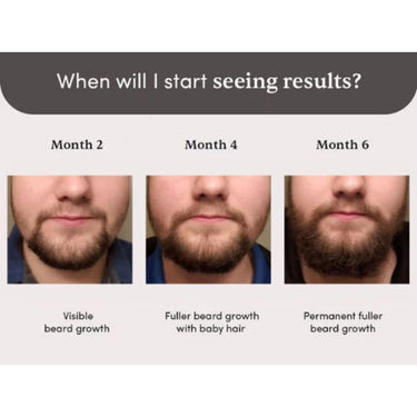 Man Matters Beardmax Growth Serum 30ml | 5% Minoxidil | Activates Beard Follicles | Solves Uneven & Patchy Beard | Alcohol Free